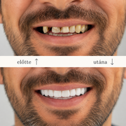 SMILEFIT PRO – NASTAVITELNÁ ZUBNÍ SADA PRO DOKONALÝ ÚSMĚV