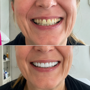SMILEFIT PRO – NASTAVITELNÁ ZUBNÍ SADA PRO DOKONALÝ ÚSMĚV